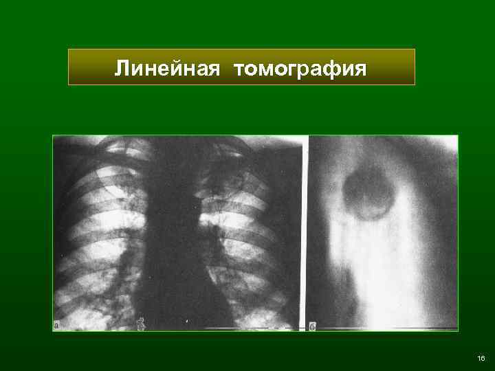 Линейная томография 16 