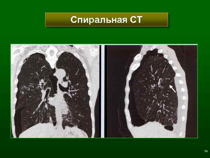 Спиральная СТ 19 