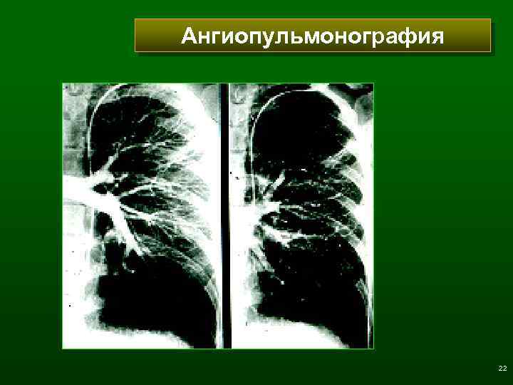 Ангиопульмонография 22 