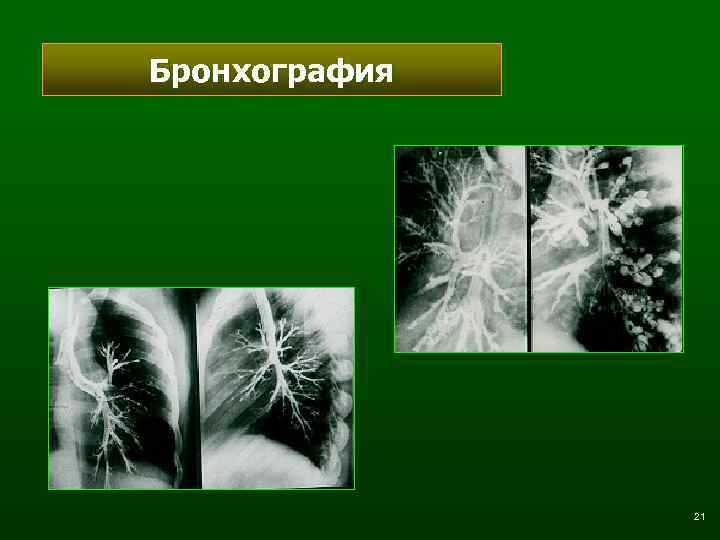 Бронхография 21 