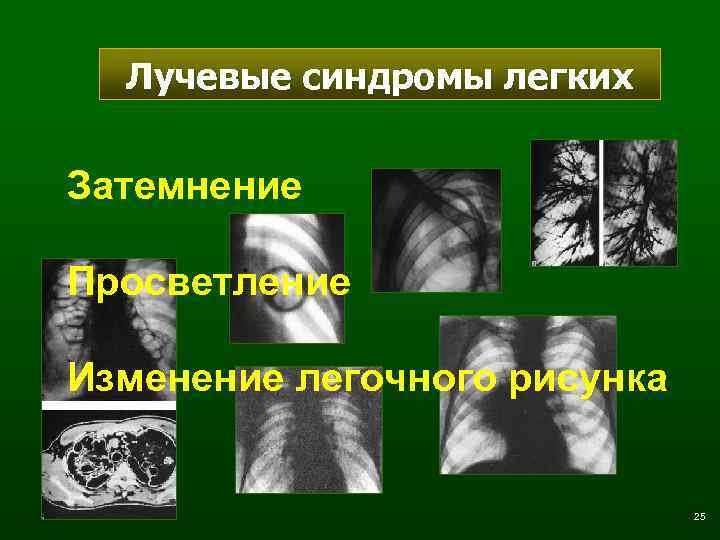 Лучевые синдромы легких Затемнение Просветление Изменение легочного рисунка 25 