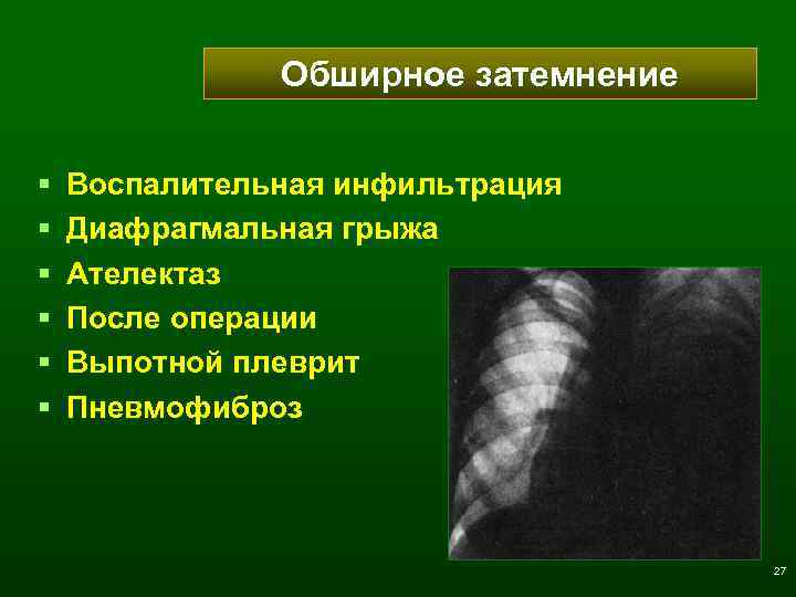 Обширное затемнение § § § Воспалительная инфильтрация Диафрагмальная грыжа Ателектаз После операции Выпотной плеврит
