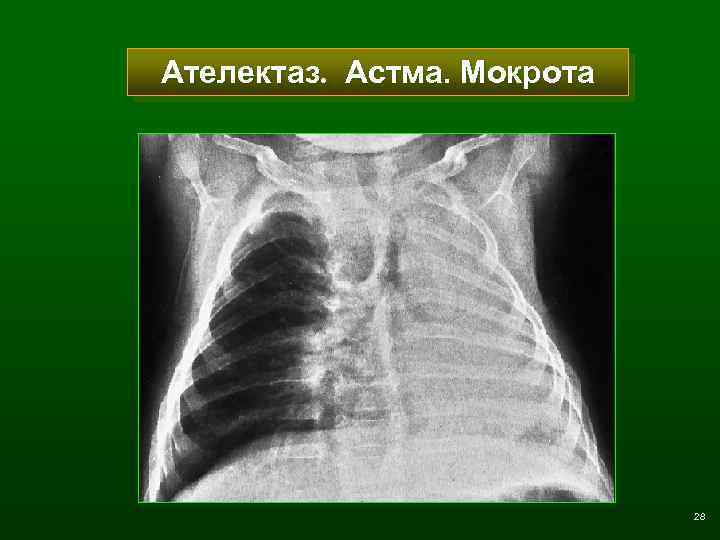 Ателектаз. Астма. Мокрота 28 