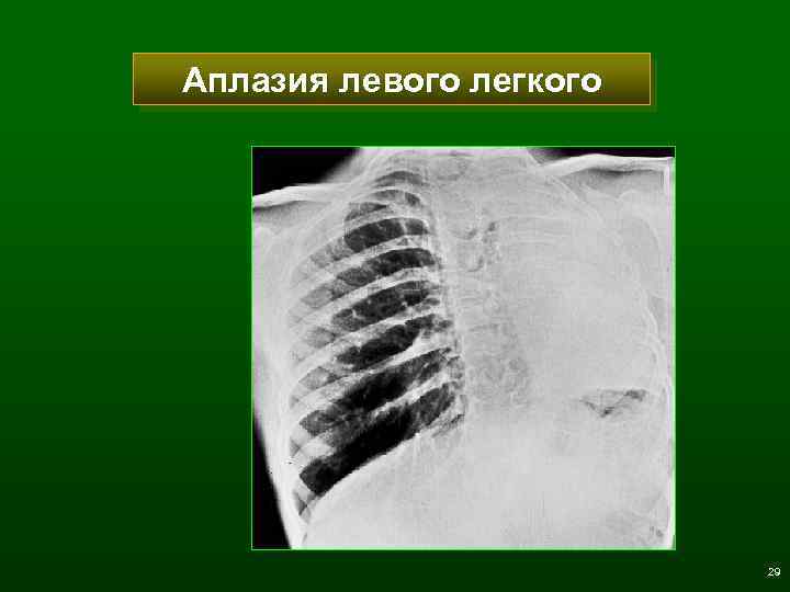 Аплазия левого легкого 29 