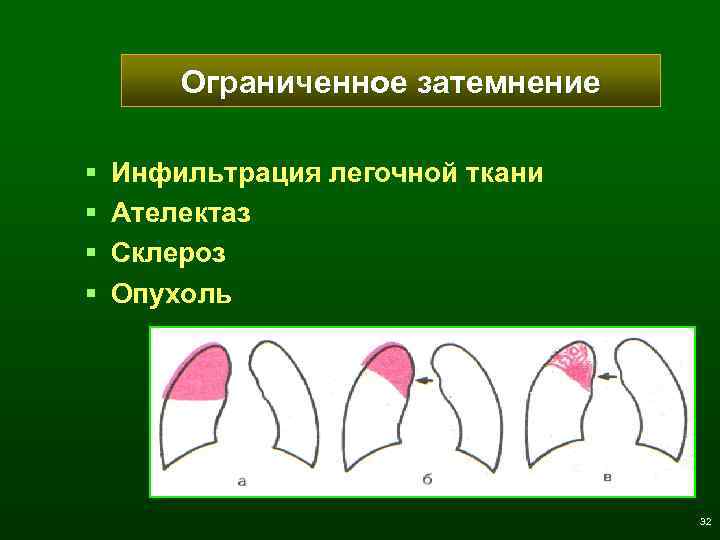 Ограниченное затемнение § § Инфильтрация легочной ткани Ателектаз Склероз Опухоль 32 