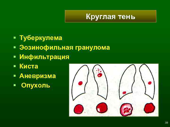 Круглая тень § § § Туберкулема Эозинофильная гранулома Инфильтрация Киста Аневризма Опухоль 33 