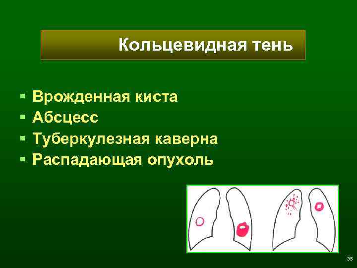 Кольцевидная тень § § Врожденная киста Абсцесс Туберкулезная каверна Распадающая опухоль 35 