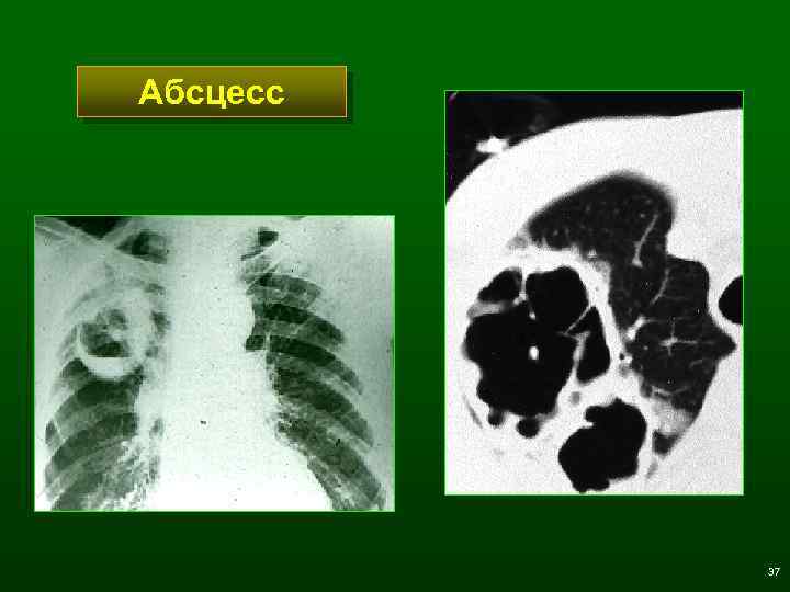 Абсцесс 37 