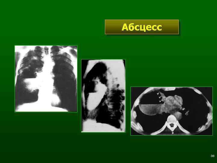 Абсцесс 38 