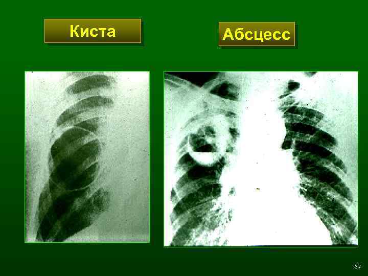 Киста Абсцесс 39 