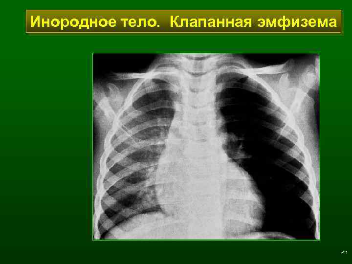 Инородное тело. Клапанная эмфизема 41 