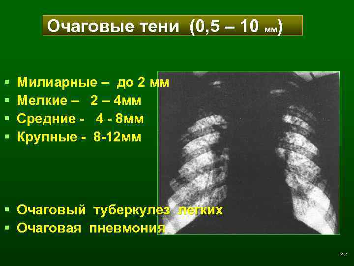 Очаговые тени (0, 5 – 10 мм) § § Милиарные – до 2 мм
