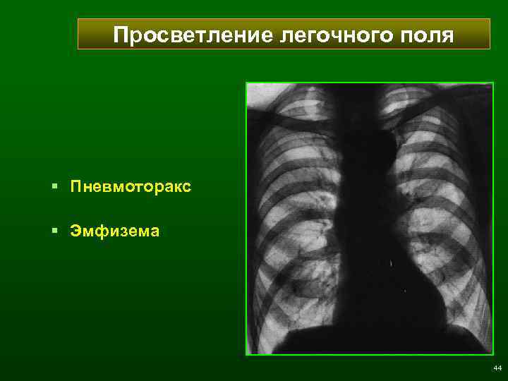 Просветление легочного поля § Пневмоторакс § Эмфизема 44 