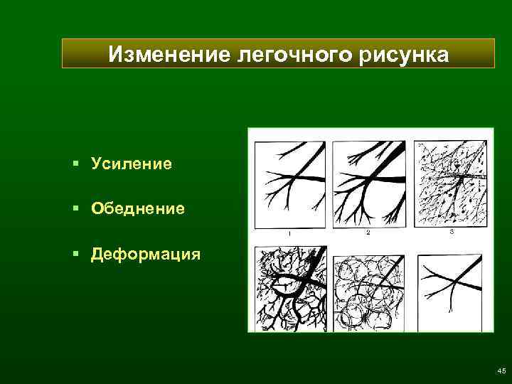 Изменение легочного рисунка § Усиление § Обеднение § Деформация 45 