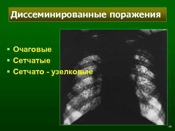 Диссеминированные поражения § Очаговые § Сетчато - узелковые 46 