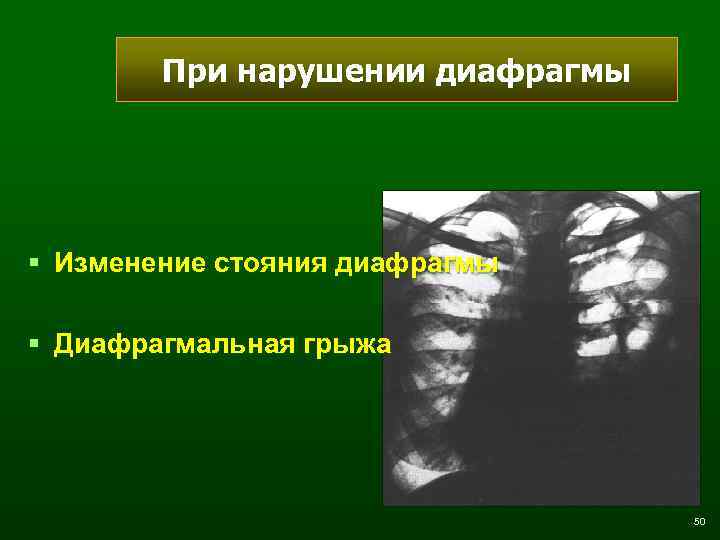 При нарушении диафрагмы § Изменение стояния диафрагмы § Диафрагмальная грыжа 50 