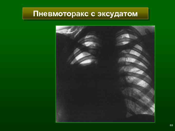 Пневмоторакс с эксудатом 63 