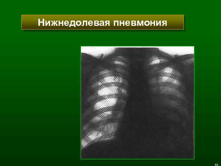Нижнедолевая пневмония 