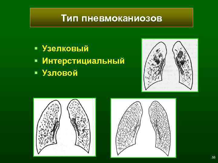 Тип пневмоканиозов § § § Узелковый Интерстициальный Узловой 56 