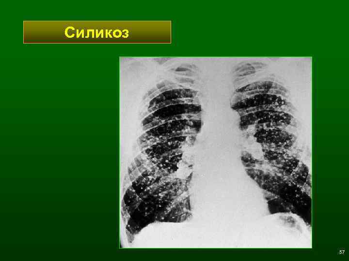 Силикоз 57 