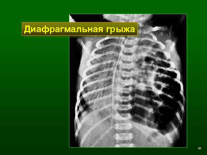 Диафрагмальная грыжа 58 