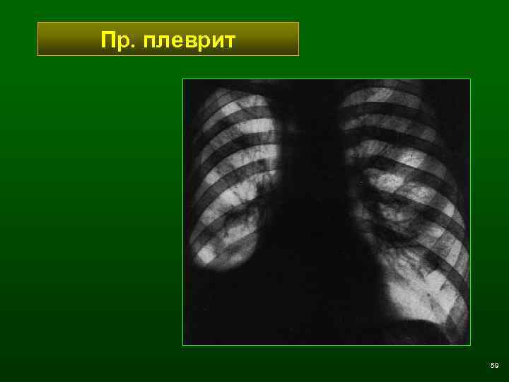 Пр. плеврит 59 