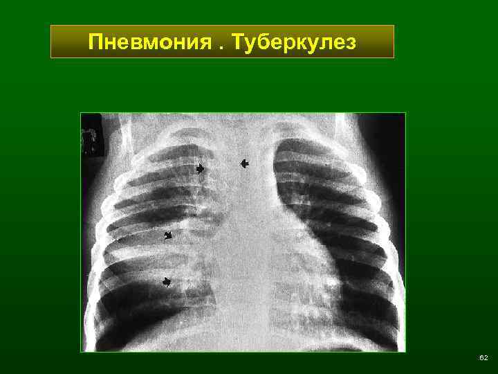 Пневмония. Туберкулез 62 