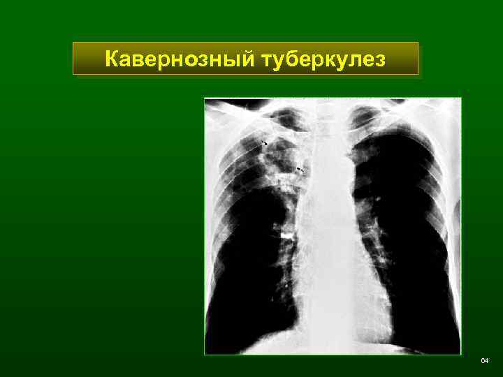 Кавернозный туберкулез 64 
