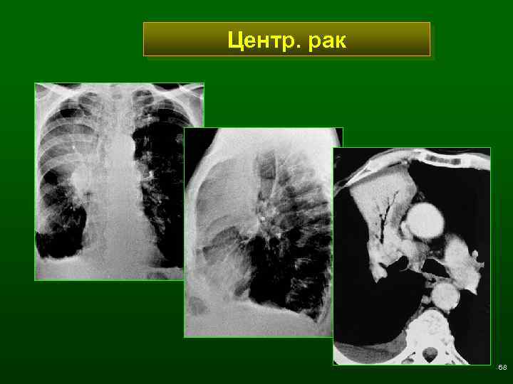 Центр. рак 68 