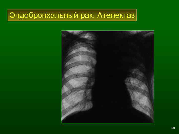 Эндобронхальный рак. Ателектаз 69 