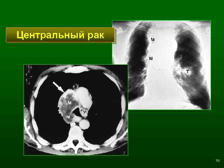 Центральный рак 70 