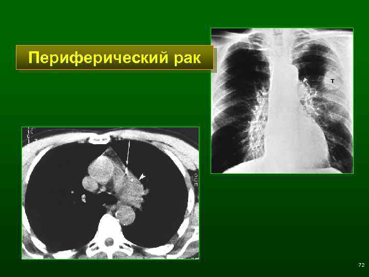 Периферический рак 72 