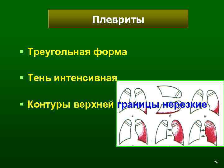 Плевриты § Треугольная форма § Тень интенсивная § Контуры верхней границы нерезкие 74 