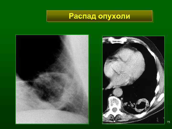 Распад опухоли 75 