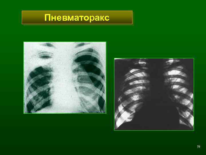 Пневматоракс 78 