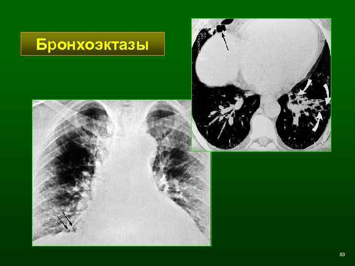 Бронхоэктазы 83 
