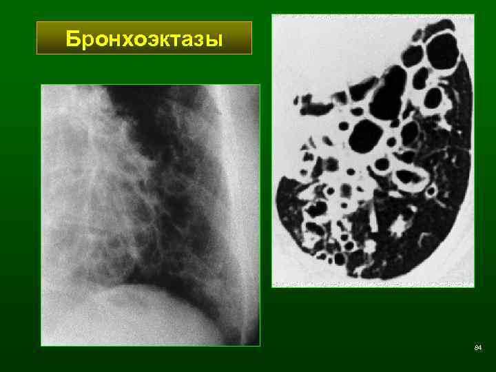 Бронхоэктазы 84 