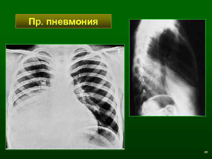 Пр. пневмония 86 