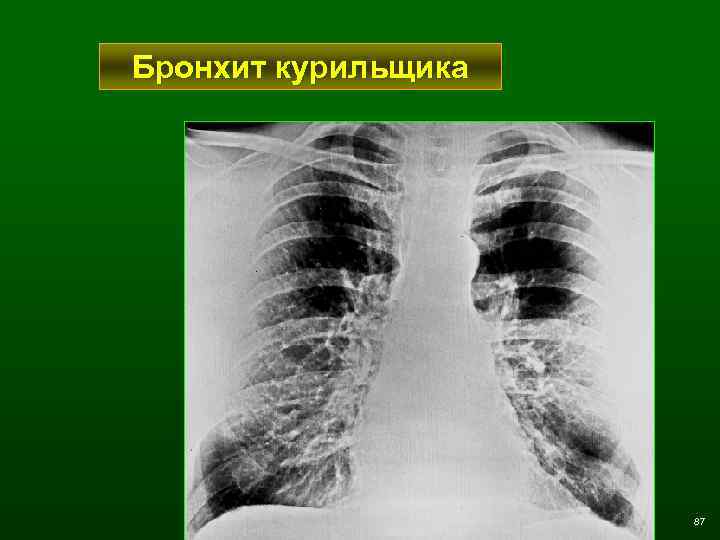 Бронхит курильщика 87 