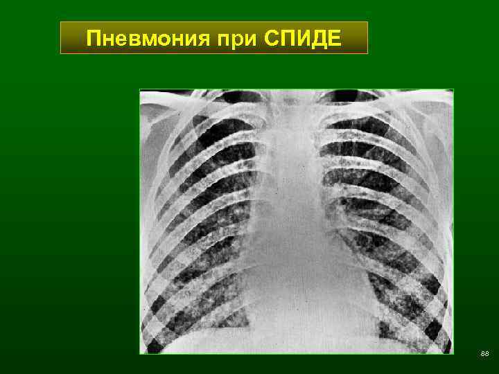 Пневмония при СПИДЕ 88 