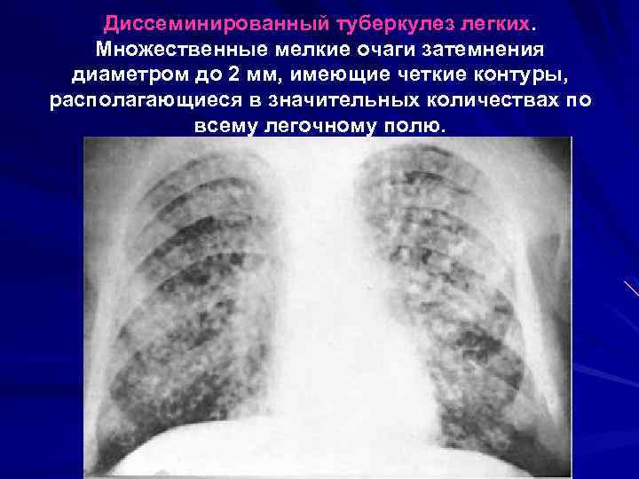 Диссеминированный туберкулез легких. Множественные мелкие очаги затемнения диаметром до 2 мм, имеющие четкие контуры,