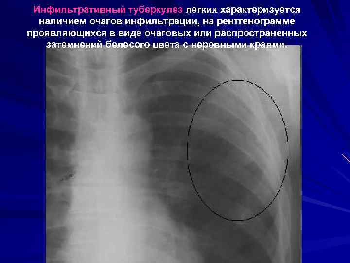 Инфильтративный туберкулез легких характеризуется наличием очагов инфильтрации, на рентгенограмме проявляющихся в виде очаговых или