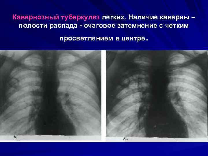 Кавернозный туберкулез легких. Наличие каверны – полости распада - очаговое затемнение с четким .