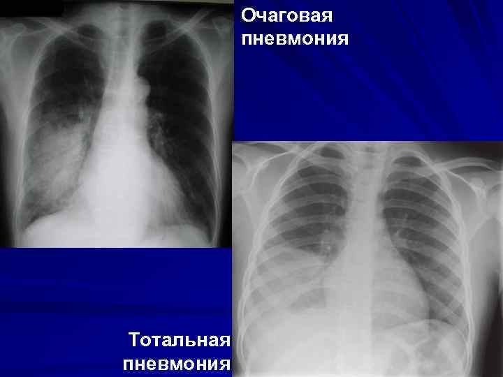 Очаговая пневмония Тотальная пневмония 