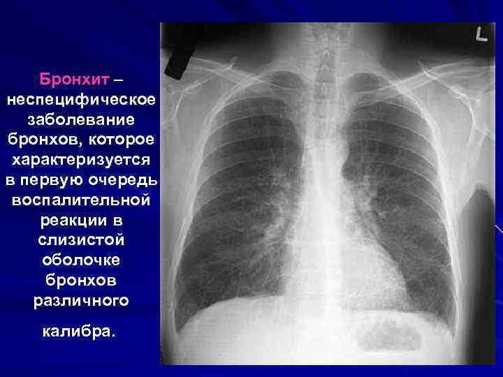 Бронхит – неспецифическое заболевание бронхов, которое характеризуется в первую очередь воспалительной реакции в слизистой