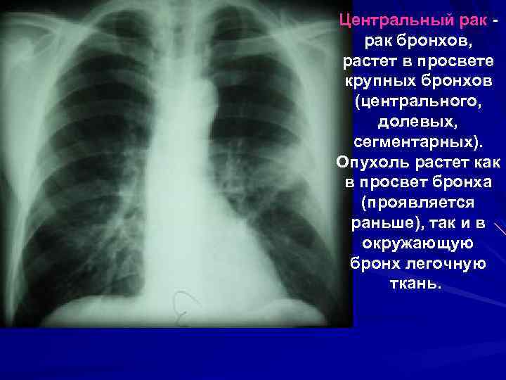 Центральный рак - рак бронхов, растет в просвете крупных бронхов (центрального, долевых, сегментарных). Опухоль