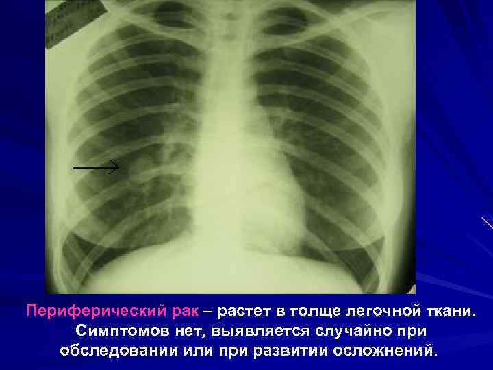 Периферический рак – растет в толще легочной ткани. Симптомов нет, выявляется случайно при обследовании