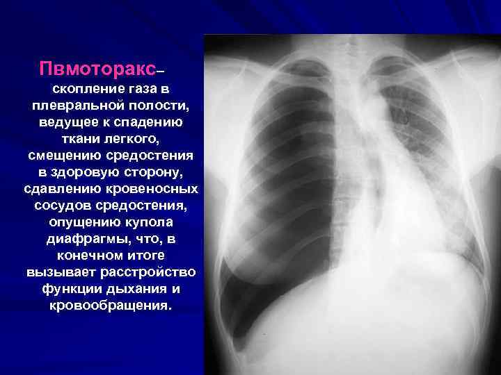 Пвмоторакс– скопление газа в плевральной полости, ведущее к спадению ткани легкого, смещению средостения в