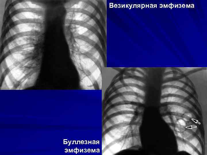 Везикулярная эмфизема Буллезная эмфизема 