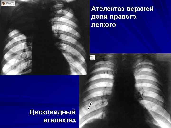 Ателектаз верхней доли правого легкого Дисковидный ателектаз 